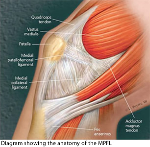 Medial Patellofemoral Ligament Injury, MPFL Tear
